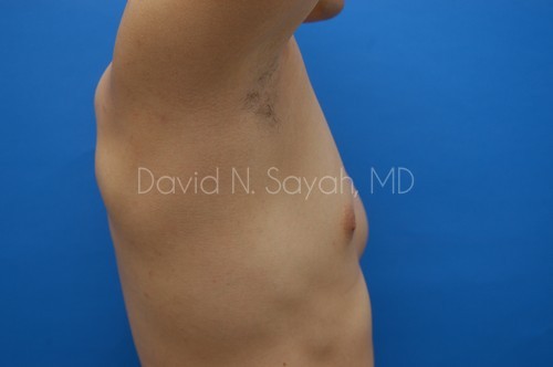 Liposuction Before and After | Sayah Institute