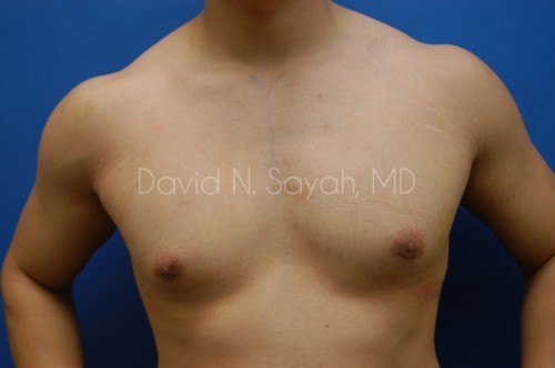 Liposuction Before and After | Sayah Institute