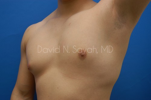 Liposuction Before and After | Sayah Institute