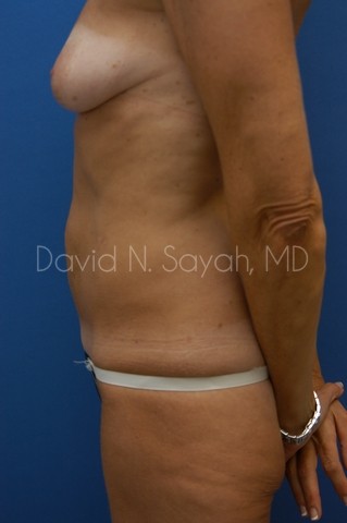 Liposuction Before and After | Sayah Institute
