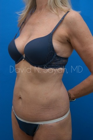 Liposuction Before and After | Sayah Institute