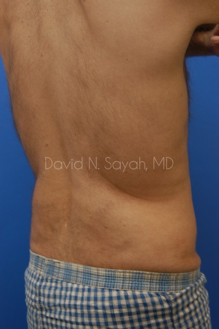 Liposuction Before and After | Sayah Institute