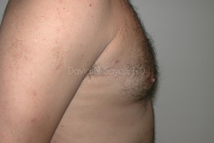 Liposuction Before and After | Sayah Institute