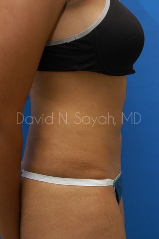 Liposuction Before and After | Sayah Institute