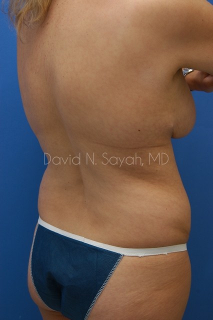 Liposuction Before and After | Sayah Institute