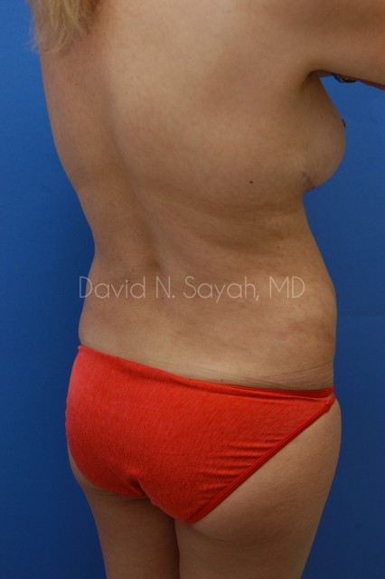 Liposuction Before and After | Sayah Institute