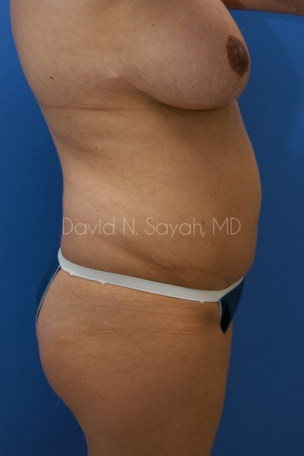 Liposuction Before and After | Sayah Institute
