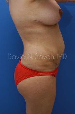 Liposuction Before and After | Sayah Institute