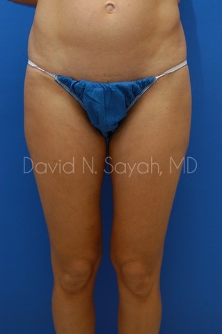 Liposuction Before and After | Sayah Institute