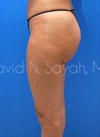 Liposuction Before and After | Sayah Institute