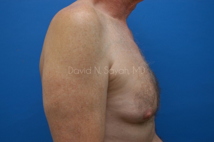 Male Breast Surgery Before and After | Sayah Institute