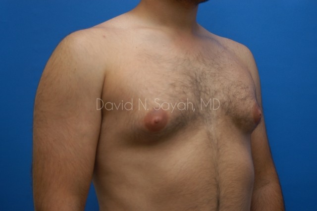 Male Breast Surgery Before and After | Sayah Institute