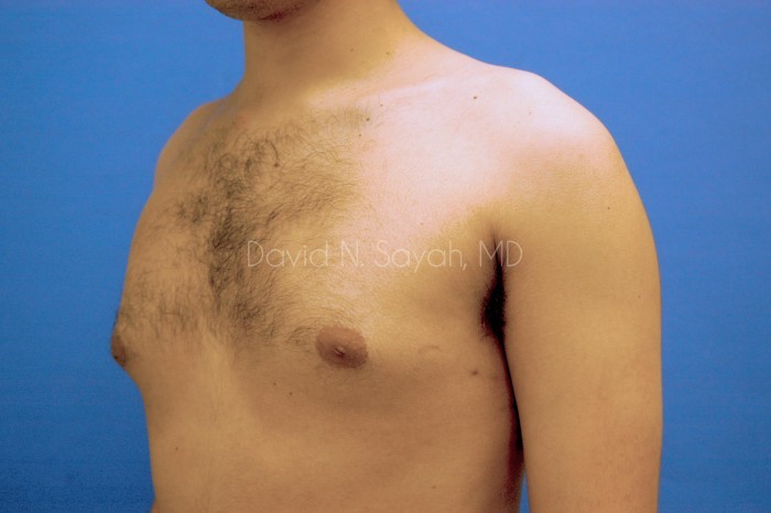 Male Breast Surgery Before and After | Sayah Institute