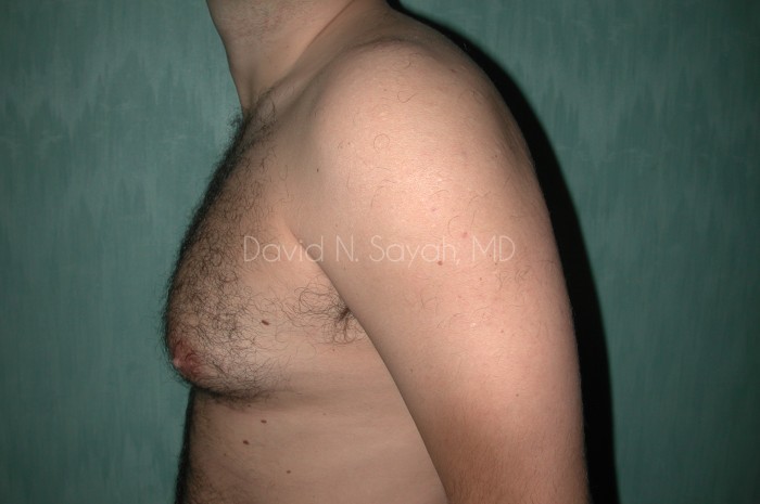 Male Breast Surgery Before and After | Sayah Institute