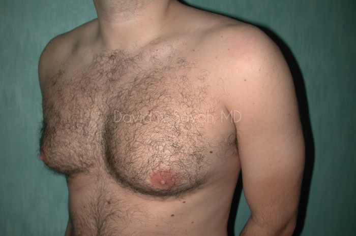 Male Breast Surgery Before and After | Sayah Institute