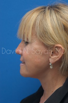 Neck Lift Before and After | Sayah Institute