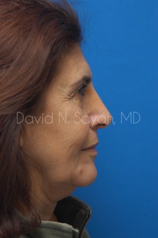 Neck Lift Before and After | Sayah Institute