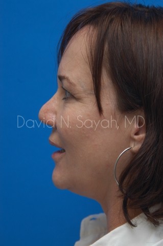 Neck Lift Before and After | Sayah Institute