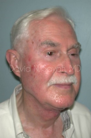 Neck Lift Before and After | Sayah Institute
