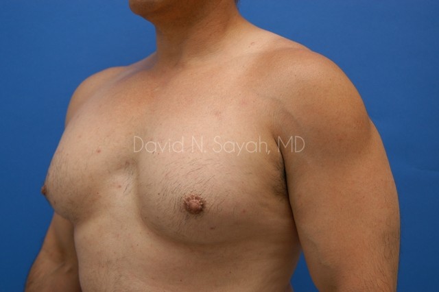 Nipple Revision Before and After | Sayah Institute