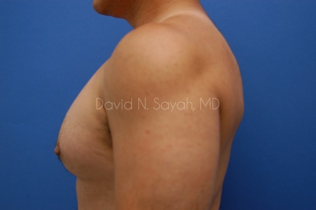 Nipple Revision Before and After | Sayah Institute