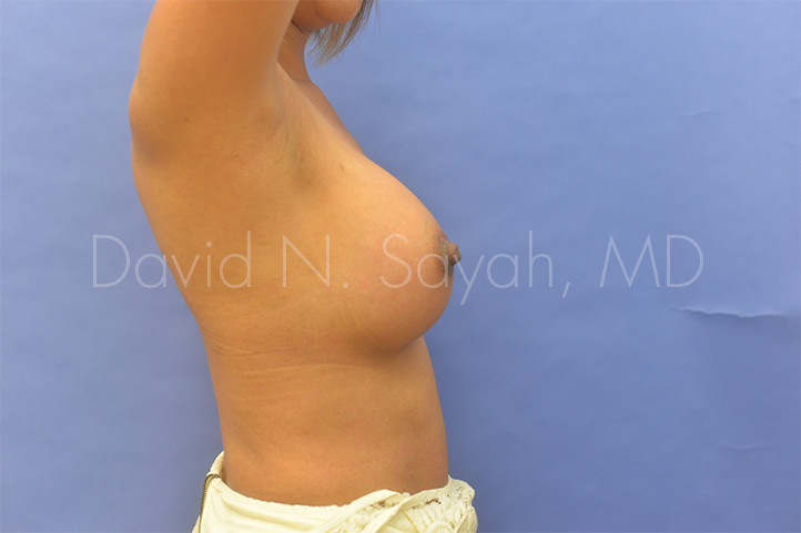 Nipple Revision Before and After | Sayah Institute