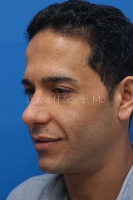 Rhinoplasty Before and After | Sayah Institute