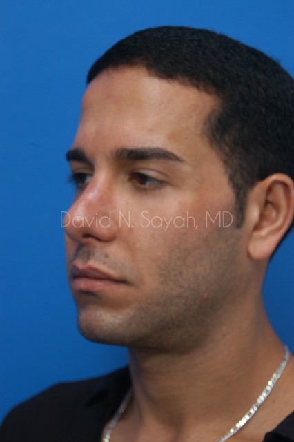 Rhinoplasty Before and After | Sayah Institute