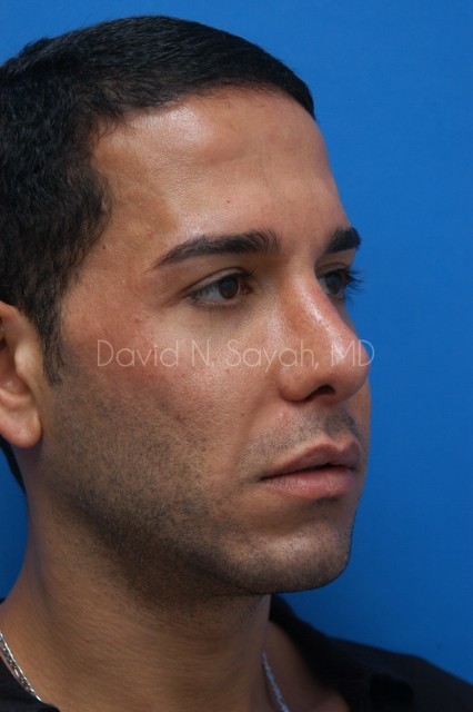 Rhinoplasty Before and After | Sayah Institute