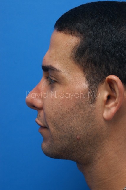 Rhinoplasty Before and After | Sayah Institute