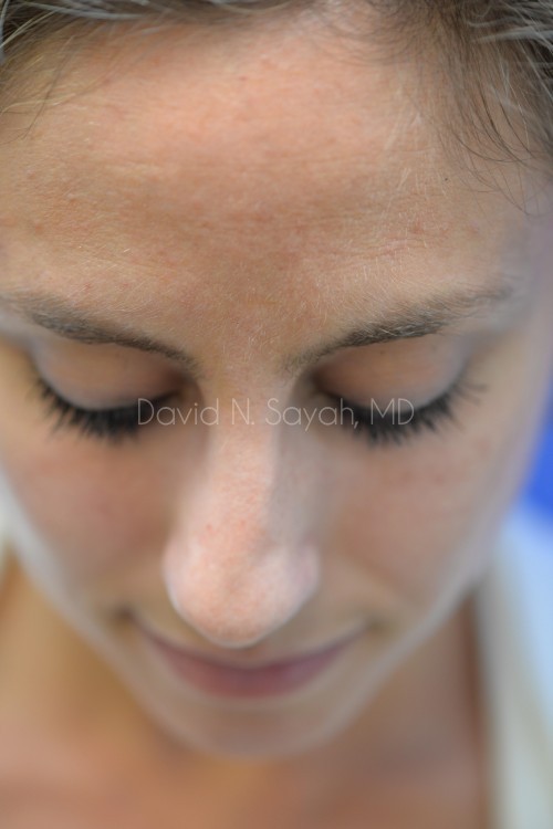 Rhinoplasty Before and After | Sayah Institute