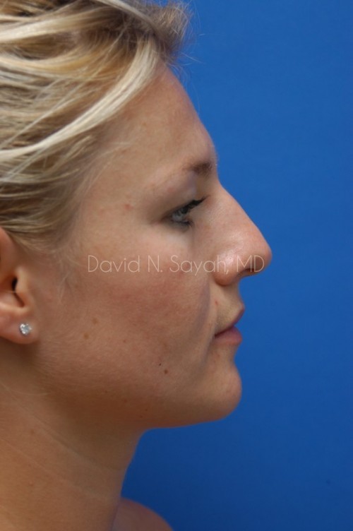 Rhinoplasty Before and After | Sayah Institute