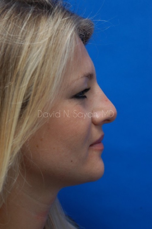 Rhinoplasty Before and After | Sayah Institute