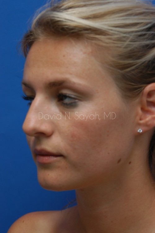 Rhinoplasty Before and After | Sayah Institute