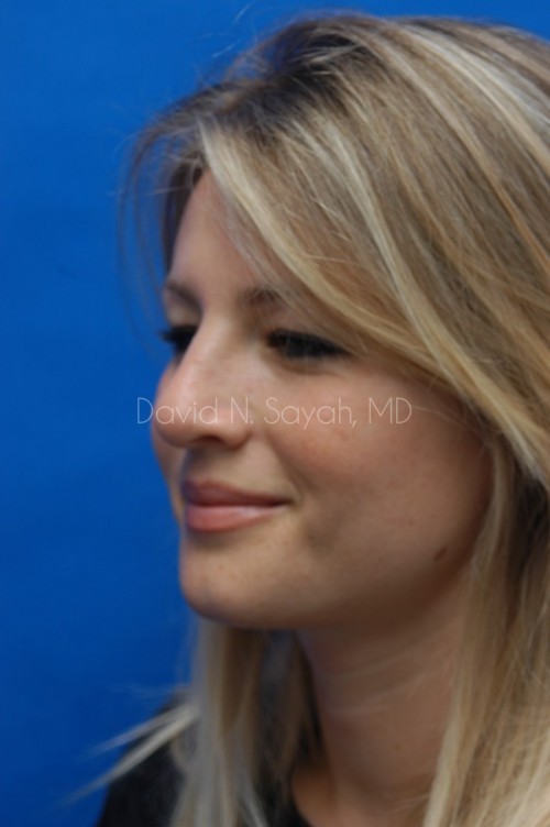 Rhinoplasty Before and After | Sayah Institute