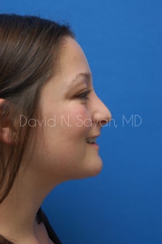 Rhinoplasty Before and After | Sayah Institute