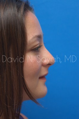 Rhinoplasty Before and After | Sayah Institute