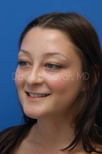 Rhinoplasty Before and After | Sayah Institute