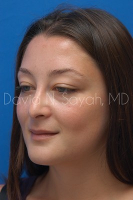Rhinoplasty Before and After | Sayah Institute