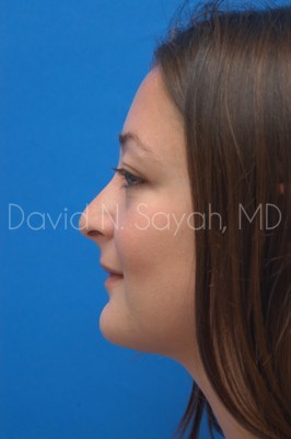 Rhinoplasty Before and After | Sayah Institute