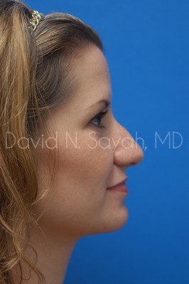 Rhinoplasty Before and After | Sayah Institute