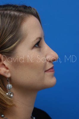 Rhinoplasty Before and After | Sayah Institute