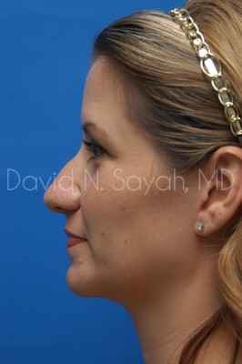 Rhinoplasty Before and After | Sayah Institute
