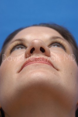 Rhinoplasty Before and After | Sayah Institute