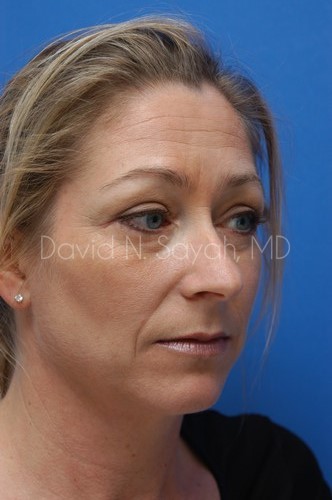 Rhinoplasty Before and After | Sayah Institute