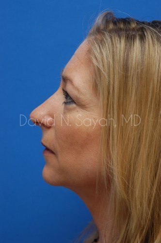 Rhinoplasty Before and After | Sayah Institute