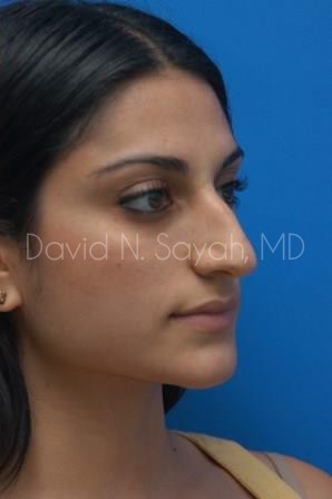 Rhinoplasty Before and After | Sayah Institute