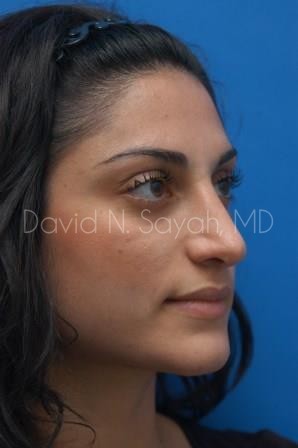 Rhinoplasty Before and After | Sayah Institute