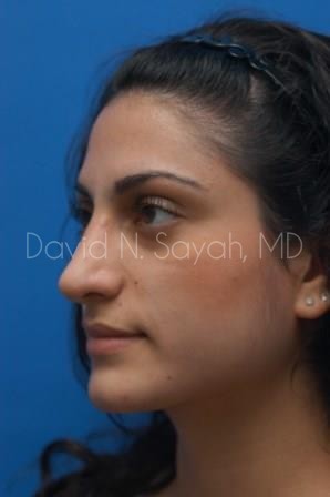 Rhinoplasty Before and After | Sayah Institute
