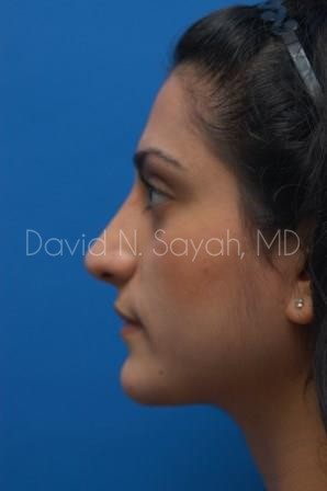 Rhinoplasty Before and After | Sayah Institute